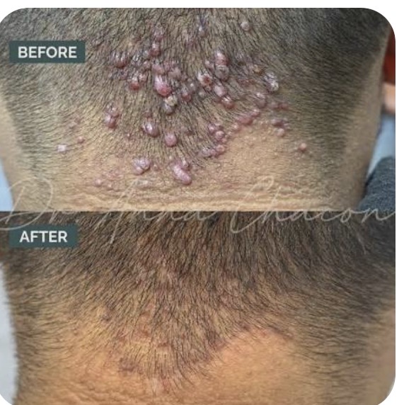 Before and after: raised AKN bumps across the back of the head and hairline, then a much smoother, calmer area with far fewer raised bumps