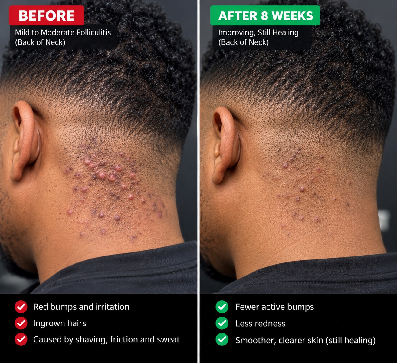 Before and after eight weeks: bumps and ingrown hairs on the back of the neck, then fewer active bumps